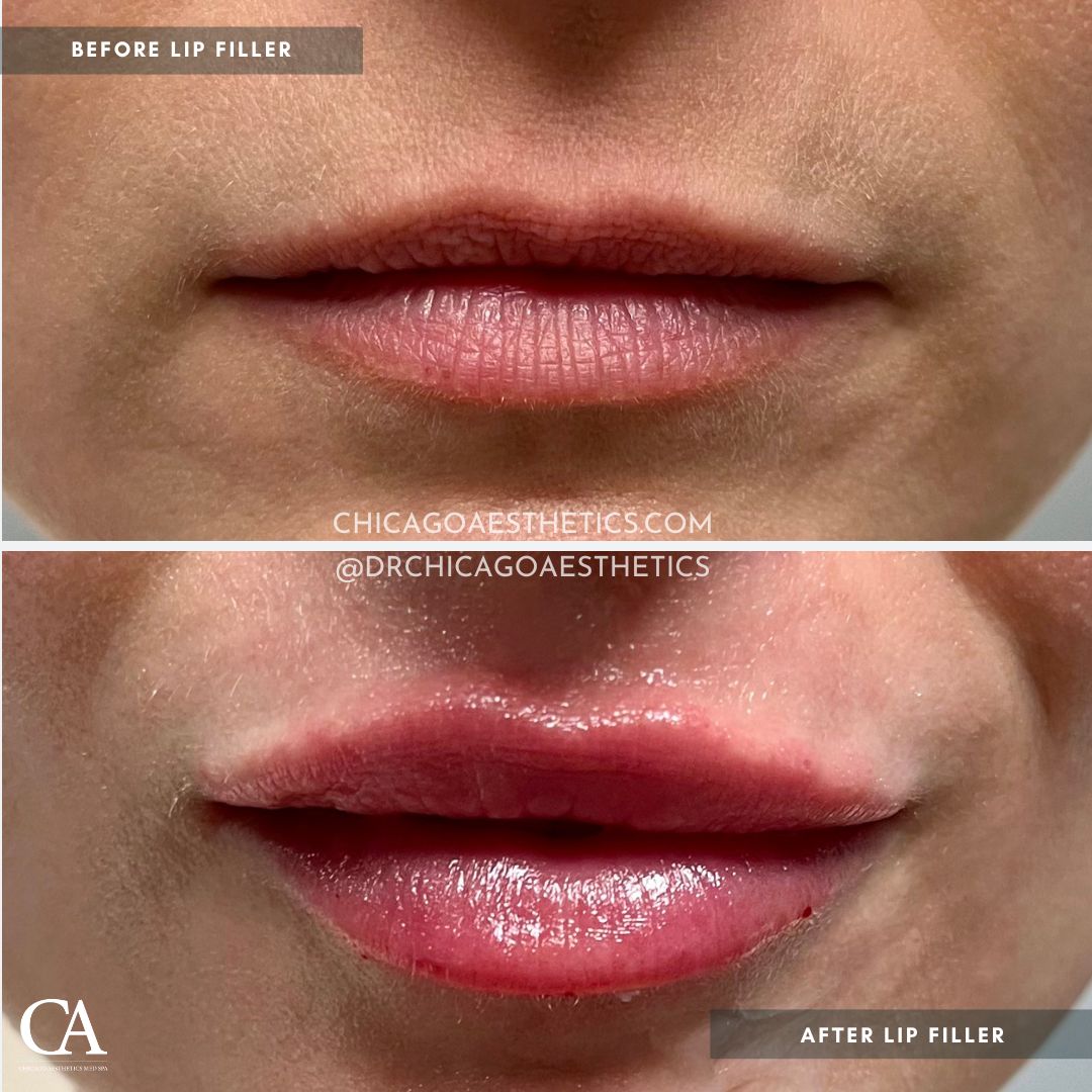 #109 Lip Filler Before After 1ml Restylane Kysse Chicago Aesthetics - CD