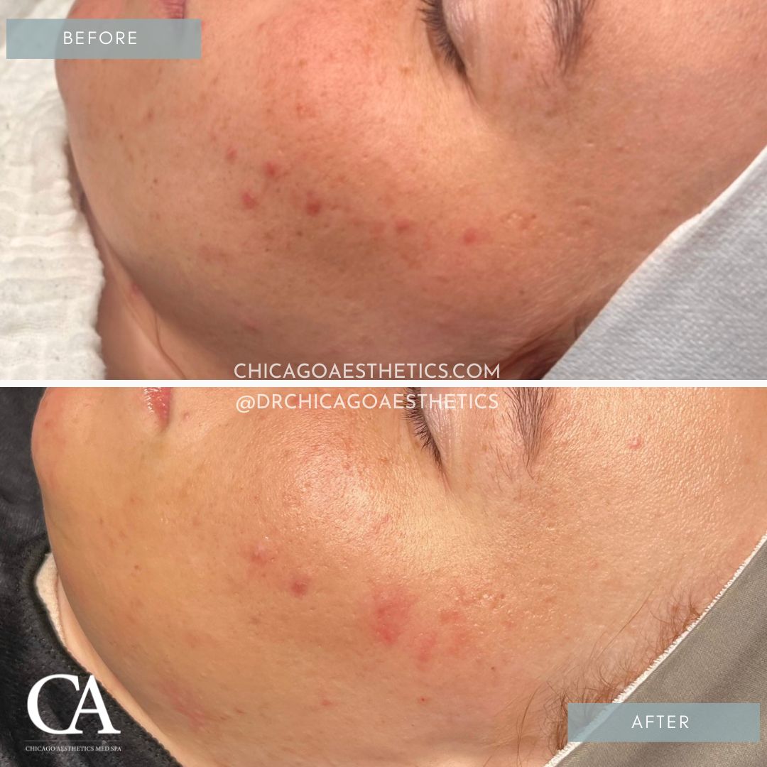 #397 IPL Before After Chicago Aesthetics