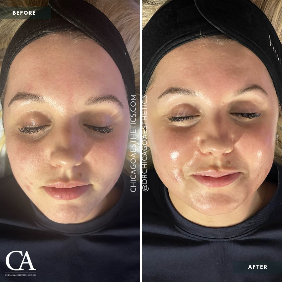 #408 Hydrafacial Before After Photo