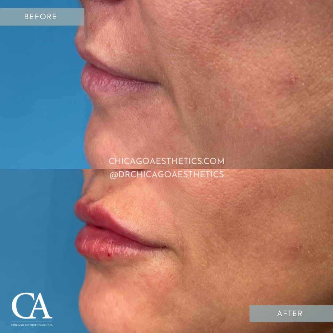 #413 Lip Filler Before After Chicago Aesthetics