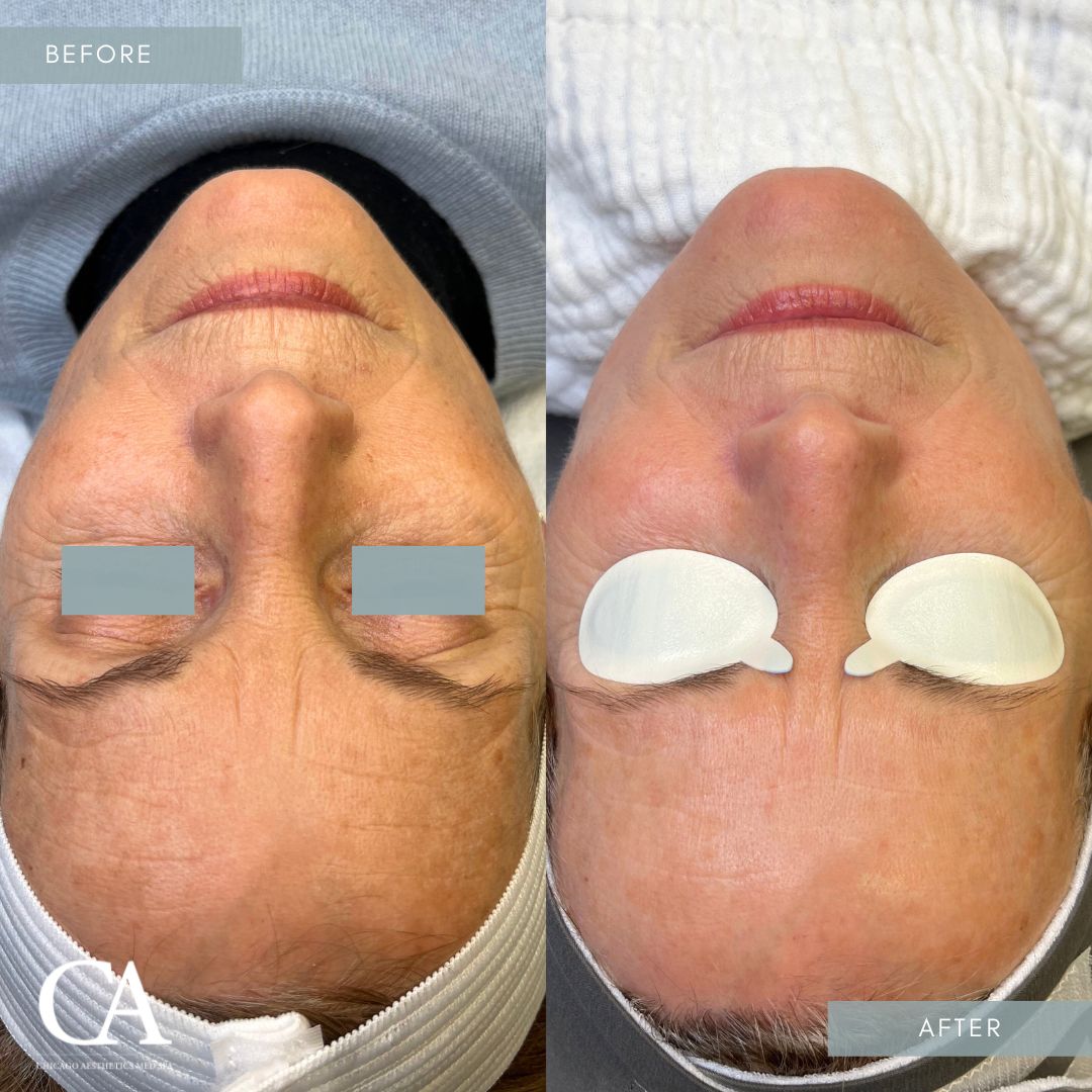 #416 IPL Lumecca Treatment Before After Chicago Aesthetics