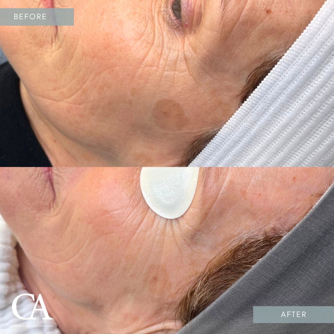 #416 IPL Lumecca Treatment Before After Chicago Aesthetics
