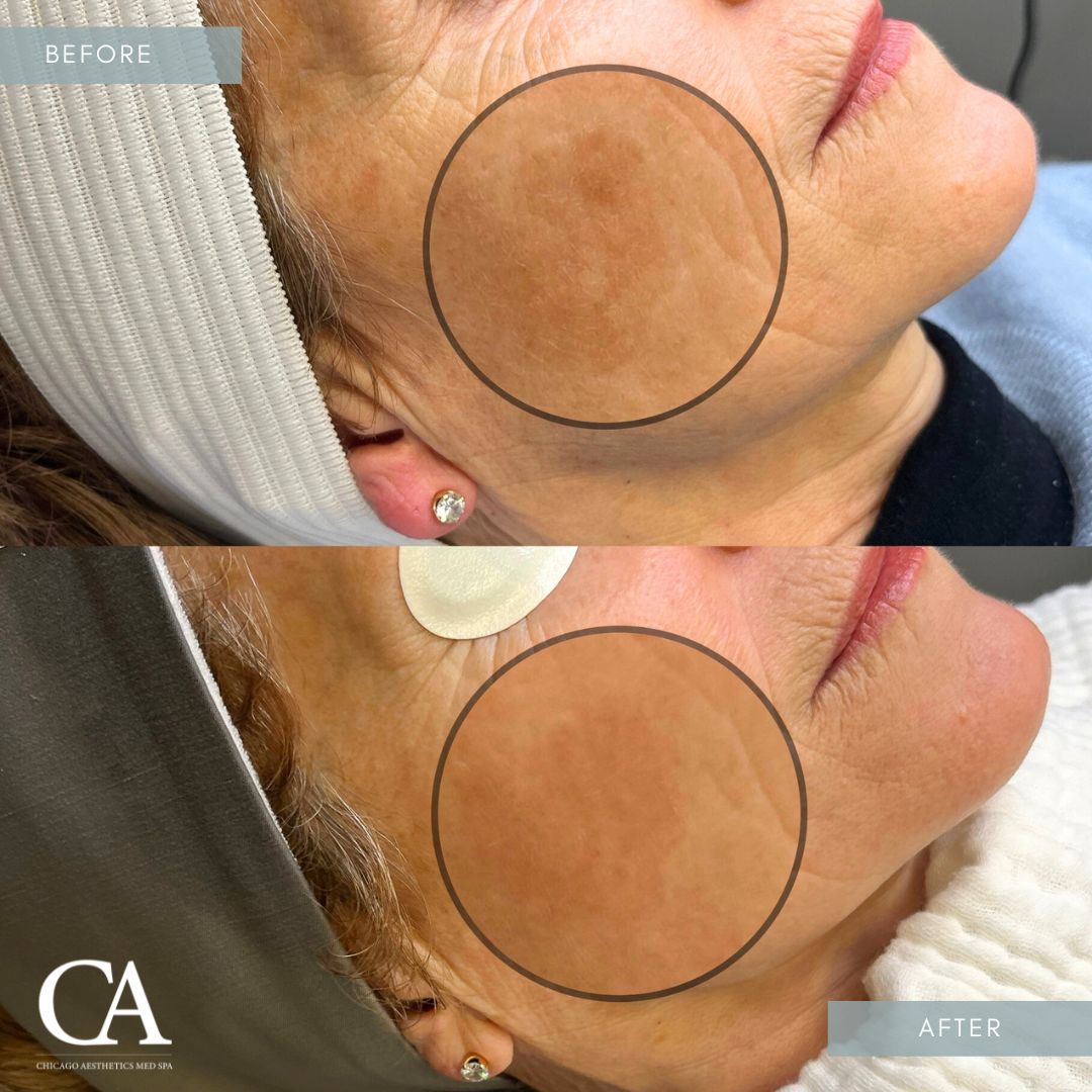 #416 IPL Lumecca Treatment Before After Chicago Aesthetics
