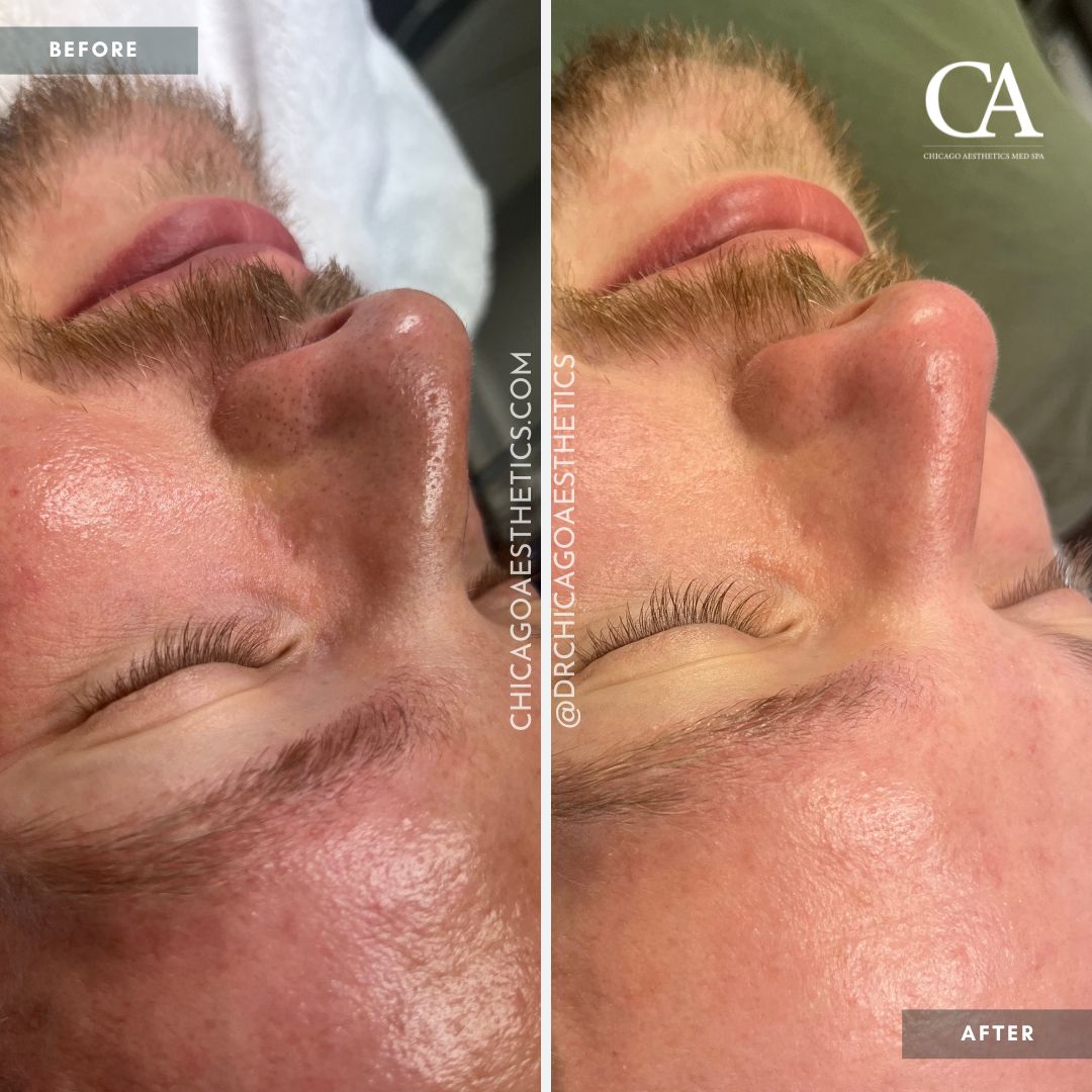 #499 Hydrafacial Before After