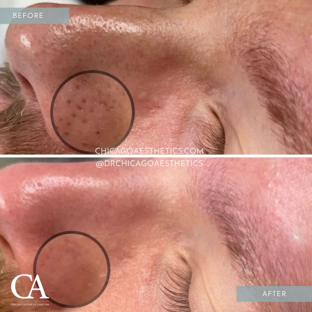 #499 Hydrafacial Before After