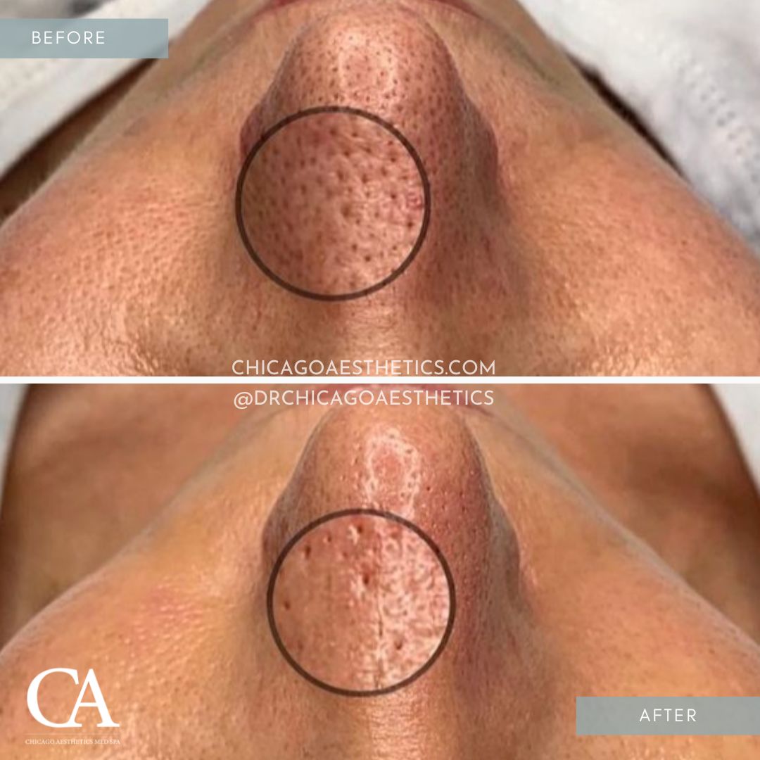 #507 Hydrafacial Before After