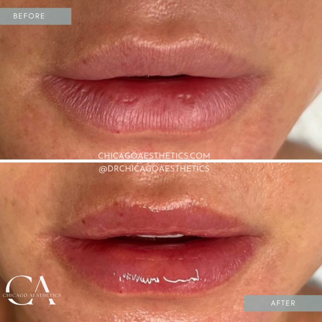 #510 Hydrafacial Lip Perk Before After Chicago Aesthetics