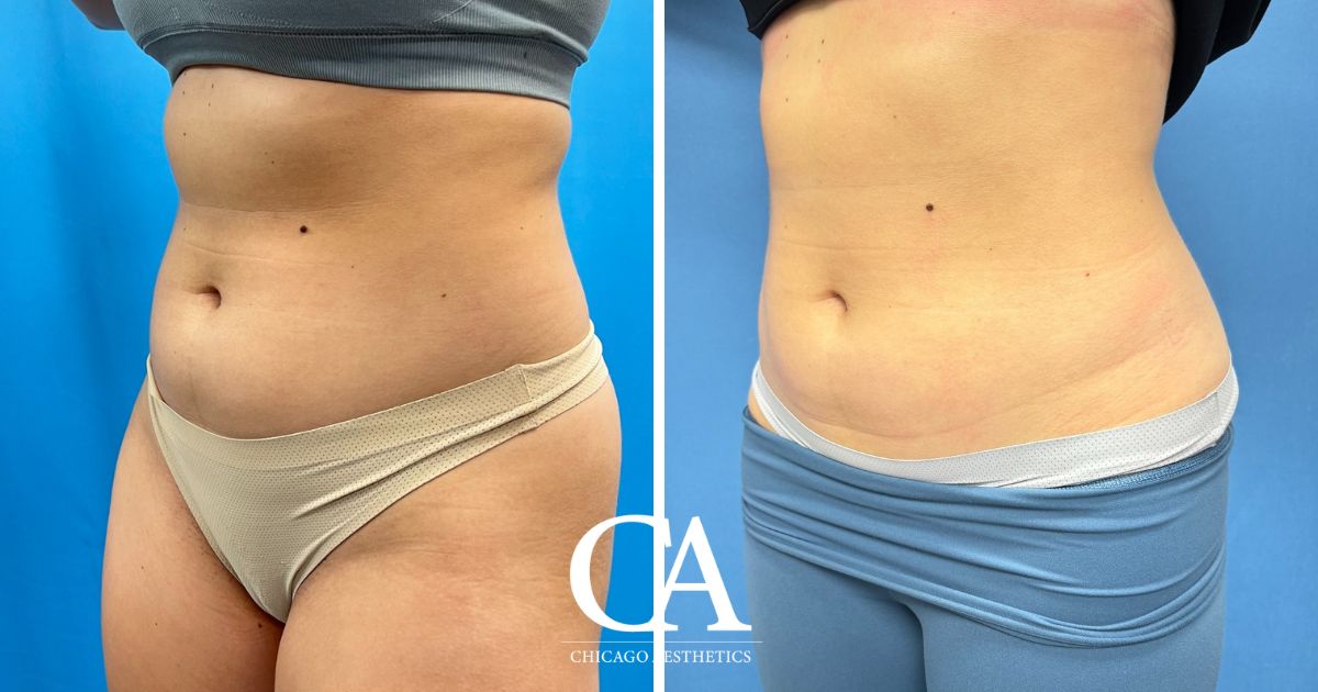 #2030159 Sculpsure before after photo 4 treatments - Chicago Aesthetics