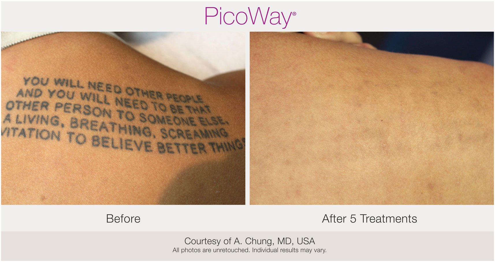 Picoway laser tattoo removal before after photo Chicago Aesthetics