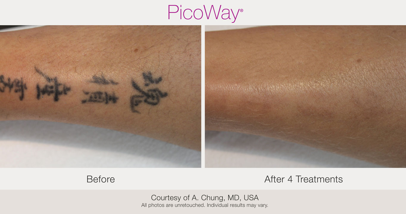 Picoway laser tattoo removal before after photo Chicago Aesthetics