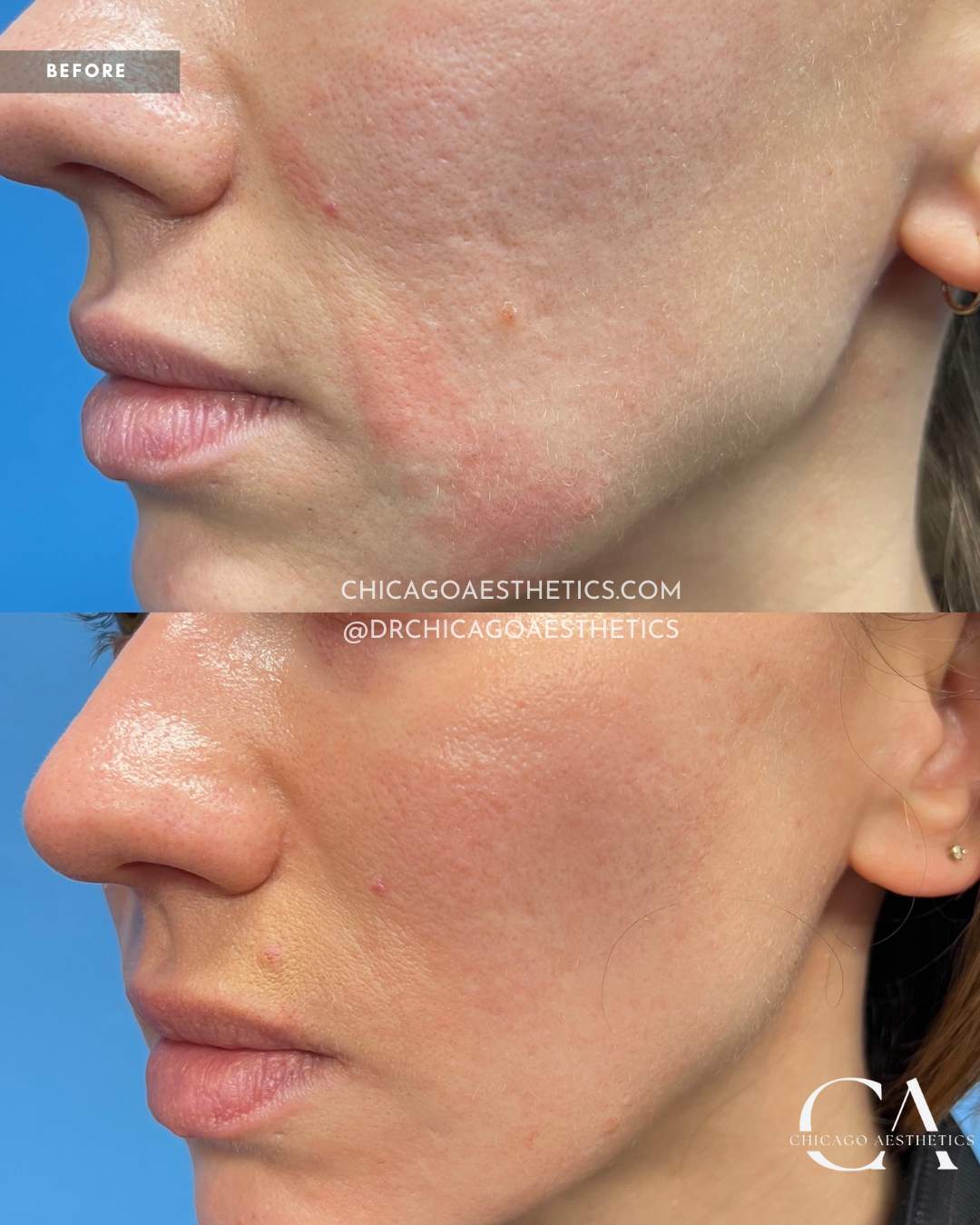 #406 Morpheus8 3 tx Face Before After Chicago Aesthetics (1)