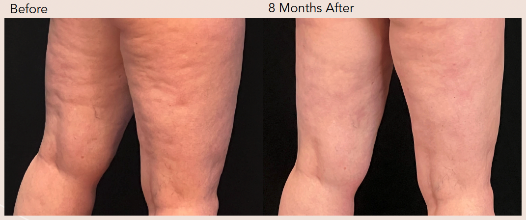 aveli cellulite treatment before after photo thighs
