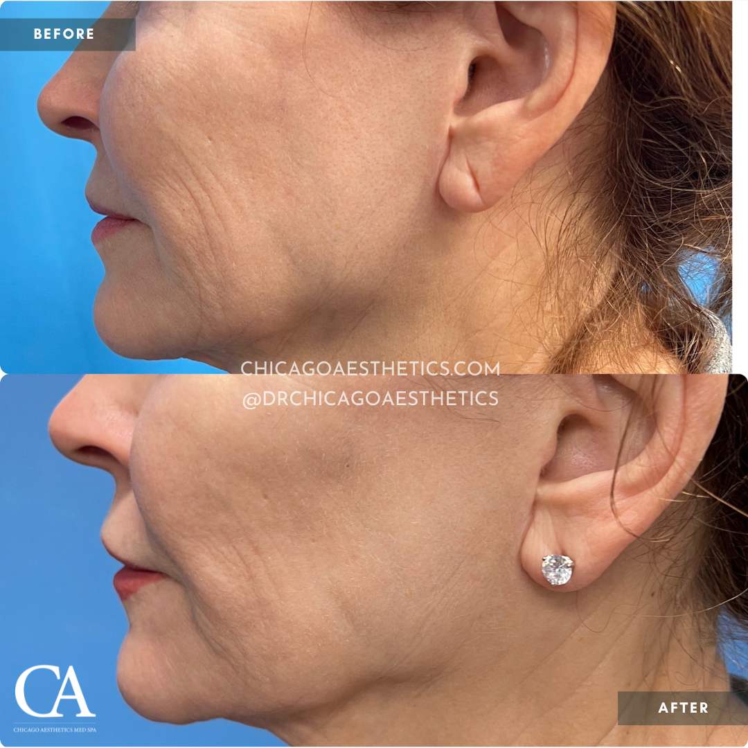 Morpheus8 Face Before After 1966575 Chicago Aesthetics - 5mos post