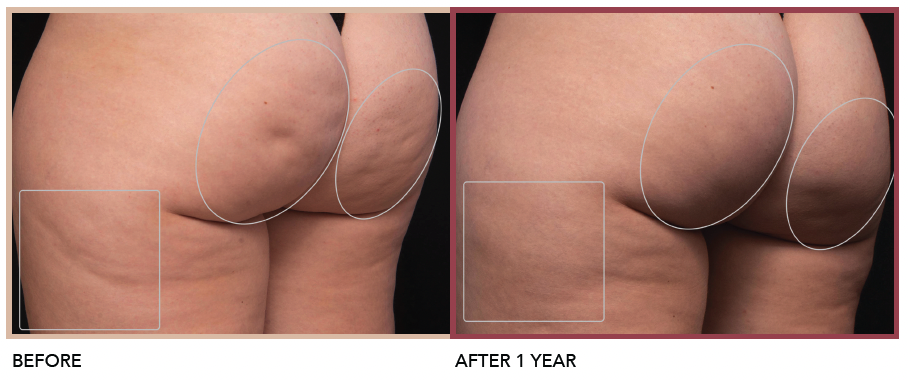 Cellulite treatment by Aveli - Chicago Aesthetics