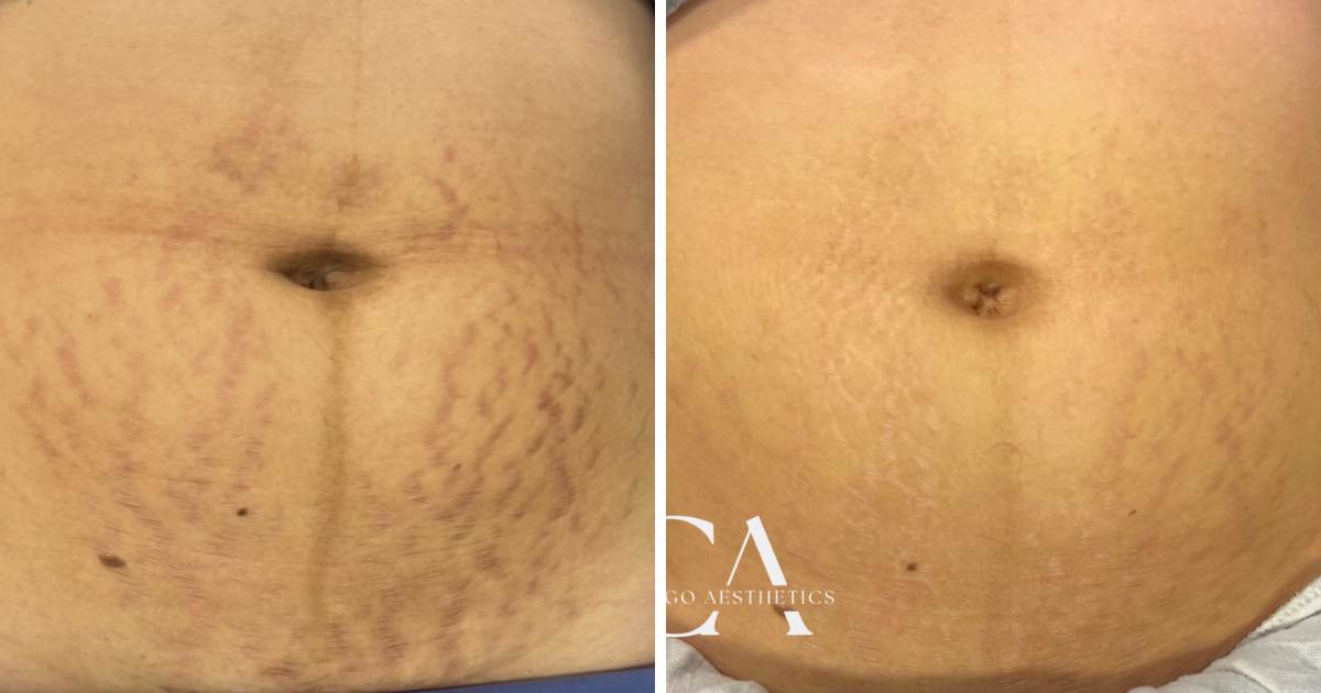 Stretch Marks Before After Photo Abdomen by Chicago Aesthetics