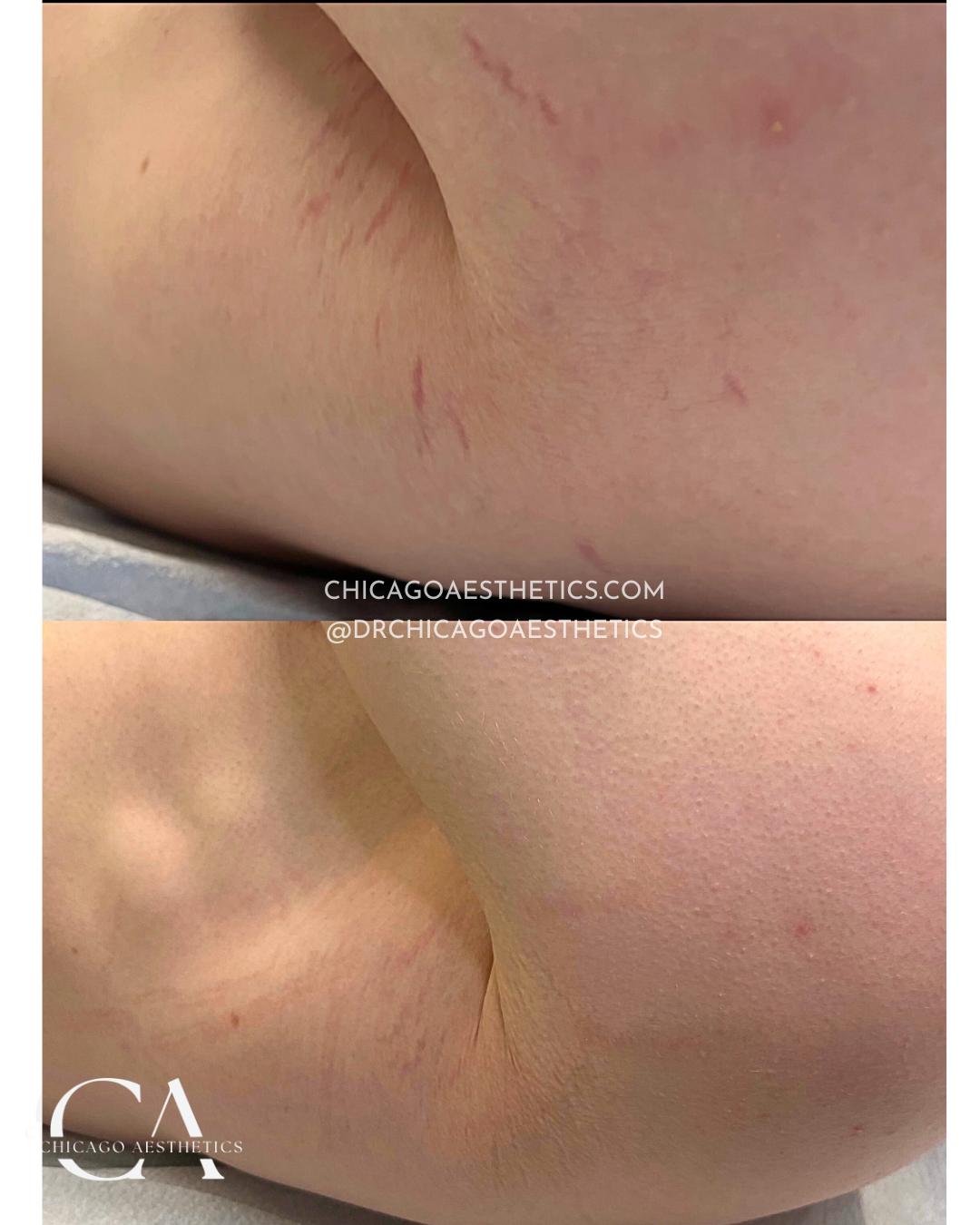 stretch marks treatment before after underarms by Chicago Aesthetics
