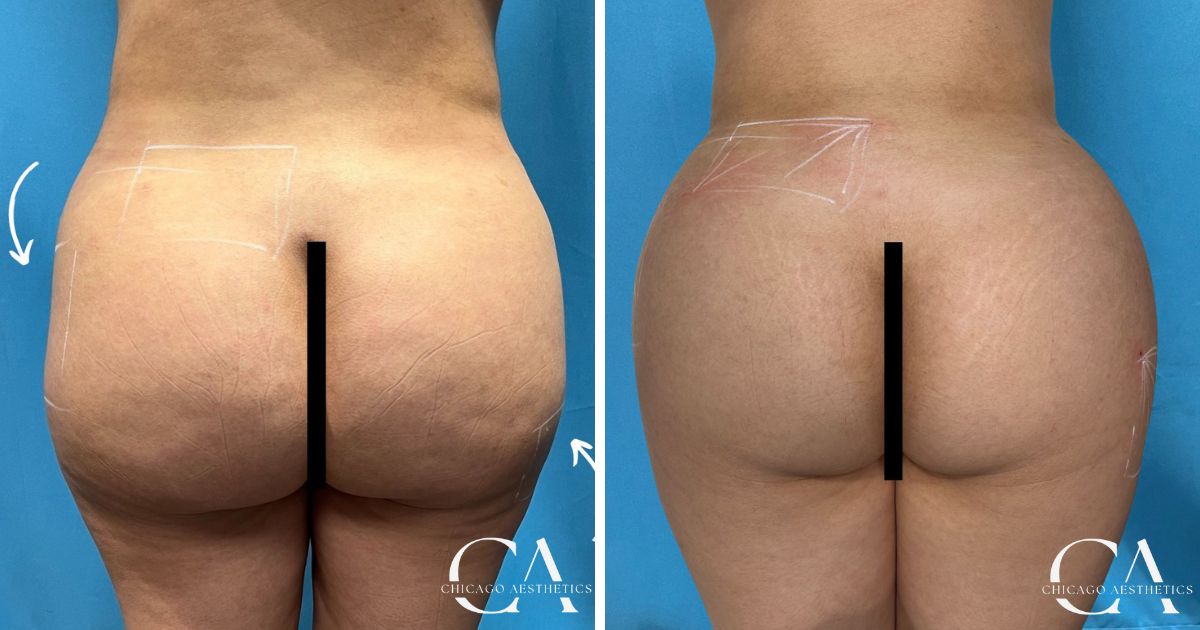 Sculptra BBL Before & After - Chicago Aesthetics