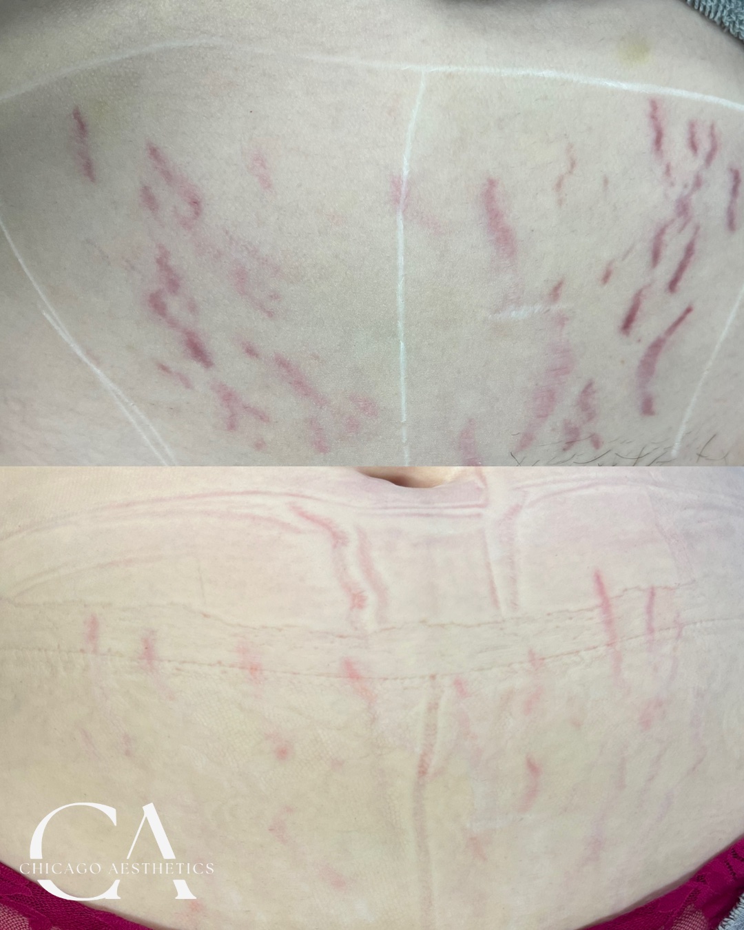 Before and After Stretch Marks Treatment - Abdomen - Chicago Aesthetics