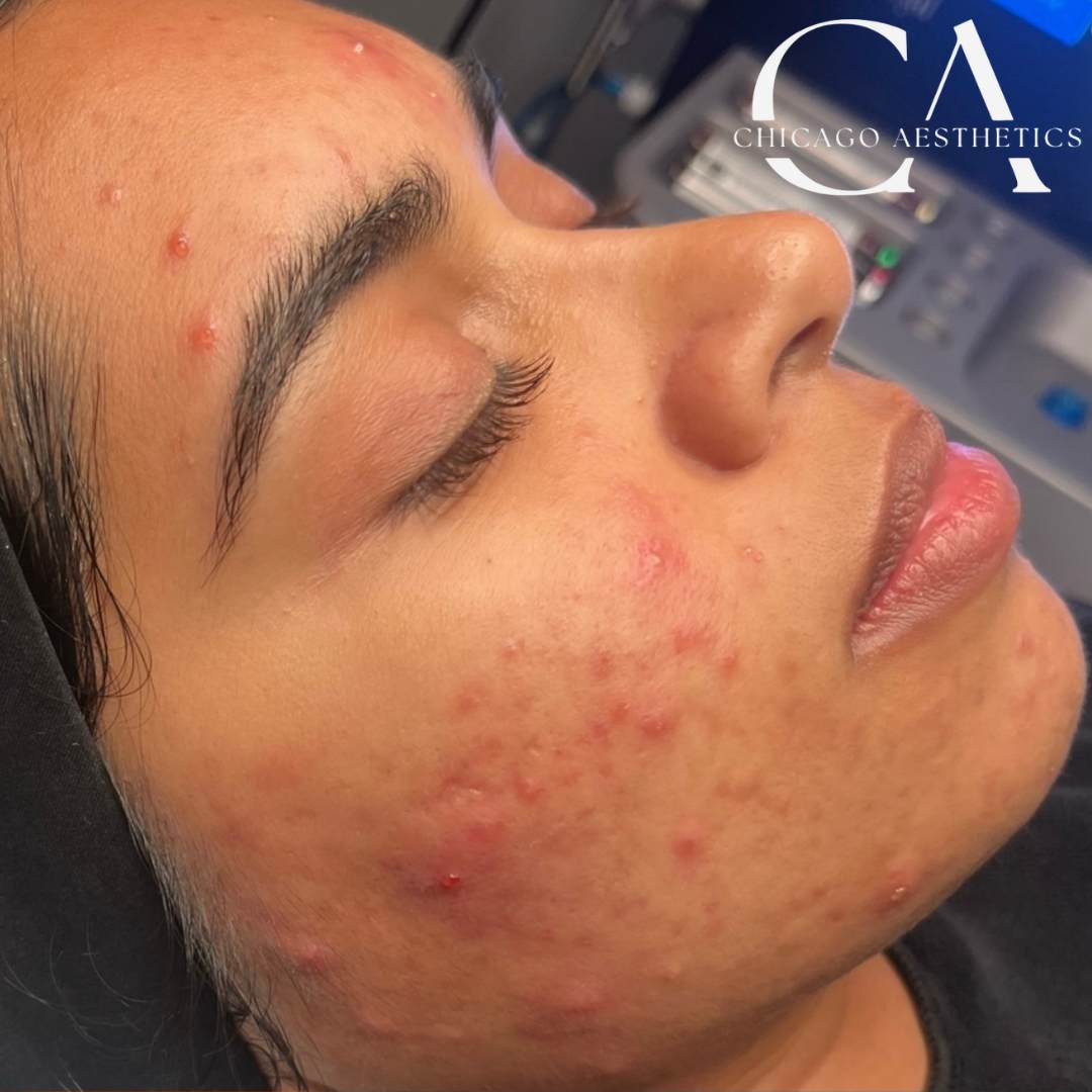 2117804 Hydrafacial Before After Photos Chicago Aesthetics