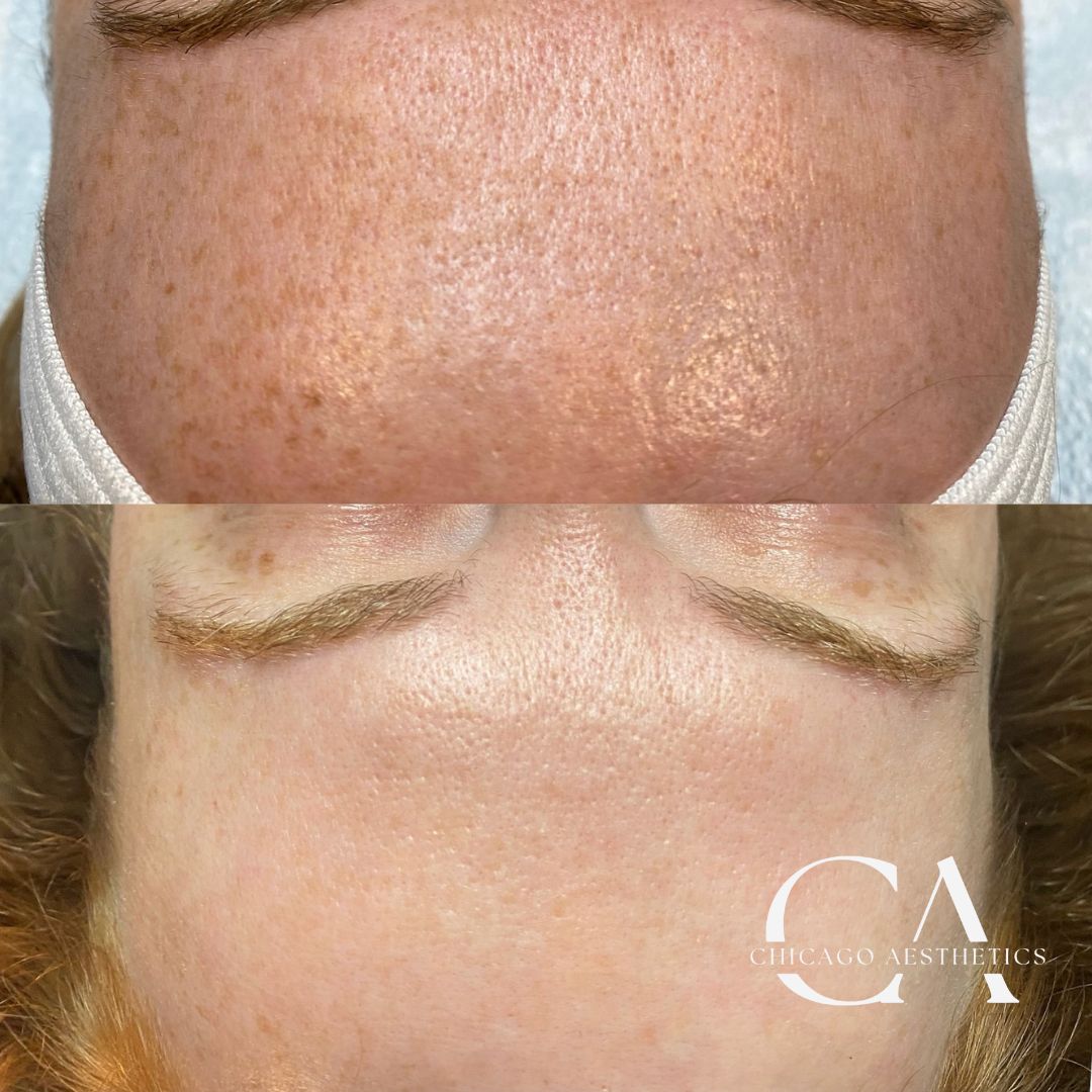 Before and After Photo IPL Forehead 1tx Chicago Aesthetics