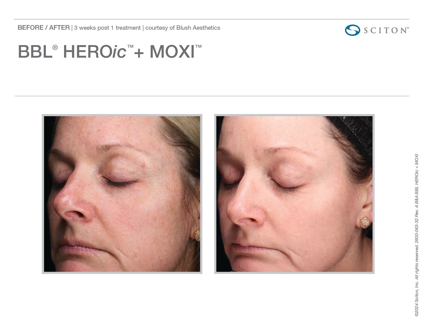 BBL HEROic Before and After Chicago Aesthetics