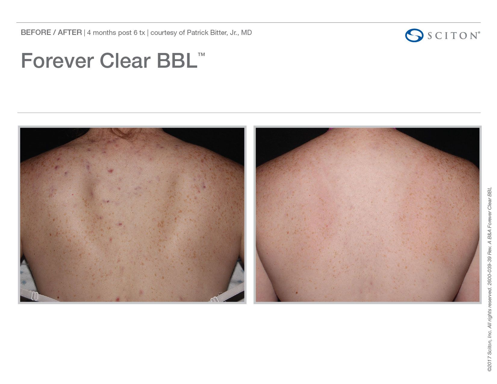BBL Forever Clear Before and After Chicago Aesthetics