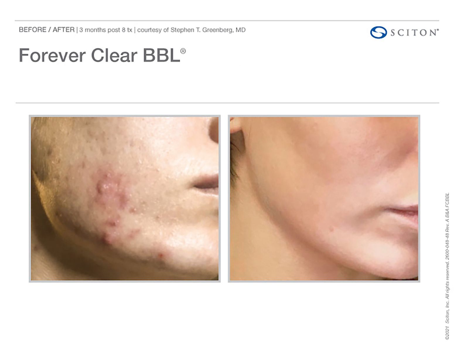 BBL Forever Clear Before and After Chicago Aesthetics