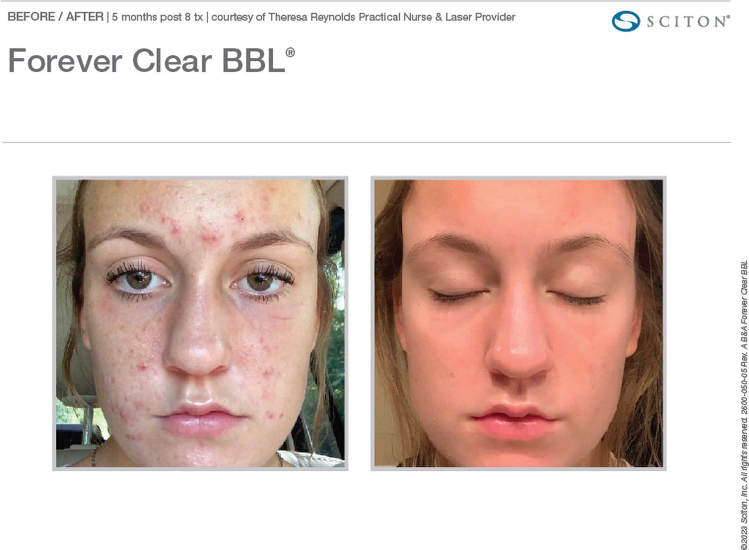 BBL Forever Clear Before and After Chicago Aesthetics