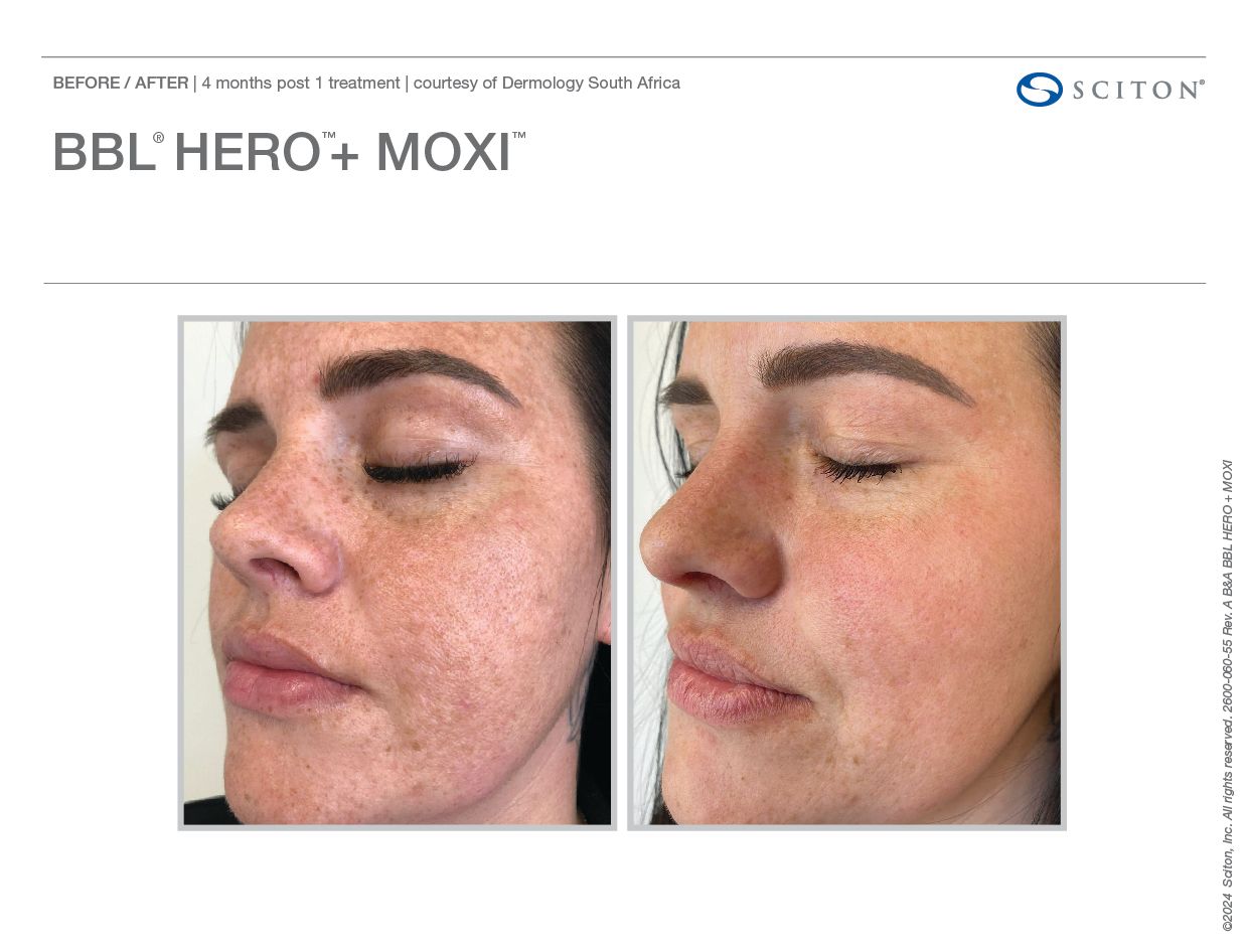 BBL HEROic Before and After Chicago Aesthetics