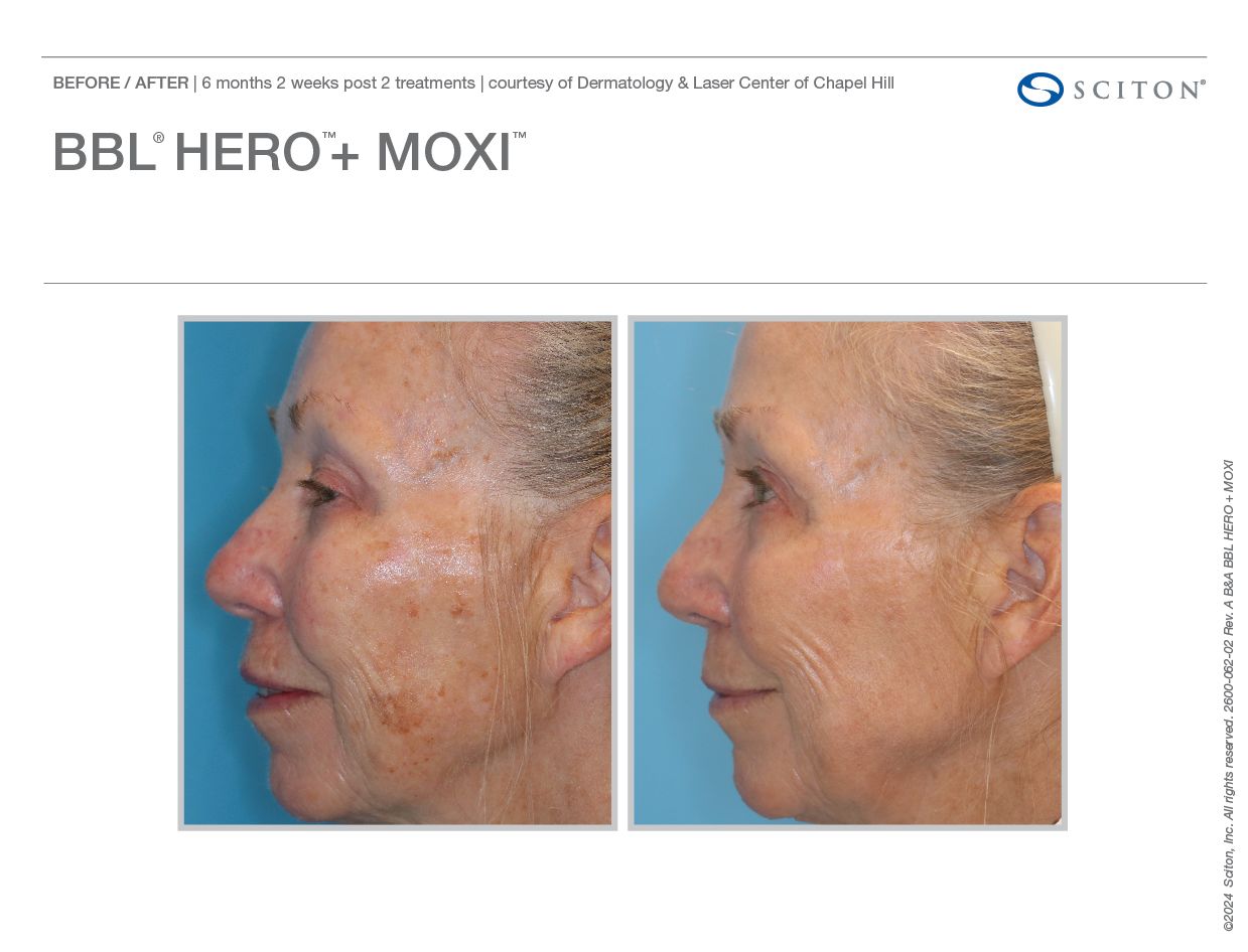 BBL HEROic Before and After Chicago Aesthetics