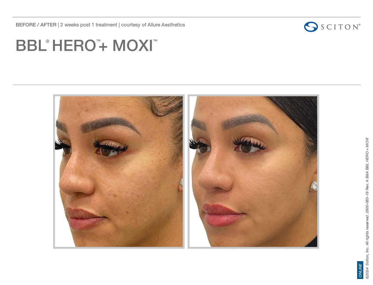 BBL HEROic Before and After Chicago Aesthetics