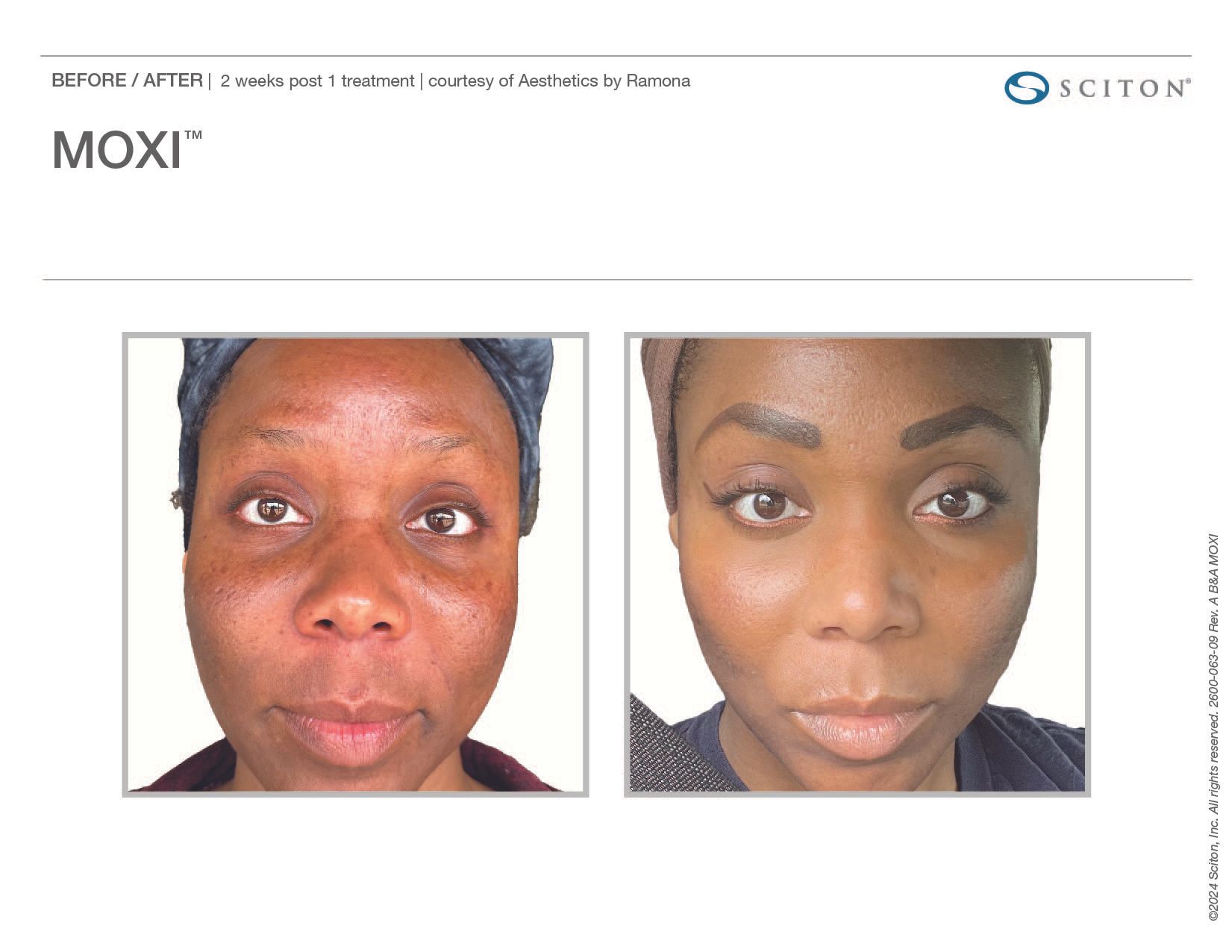 MOXI Before and After Chicago Aesthetics