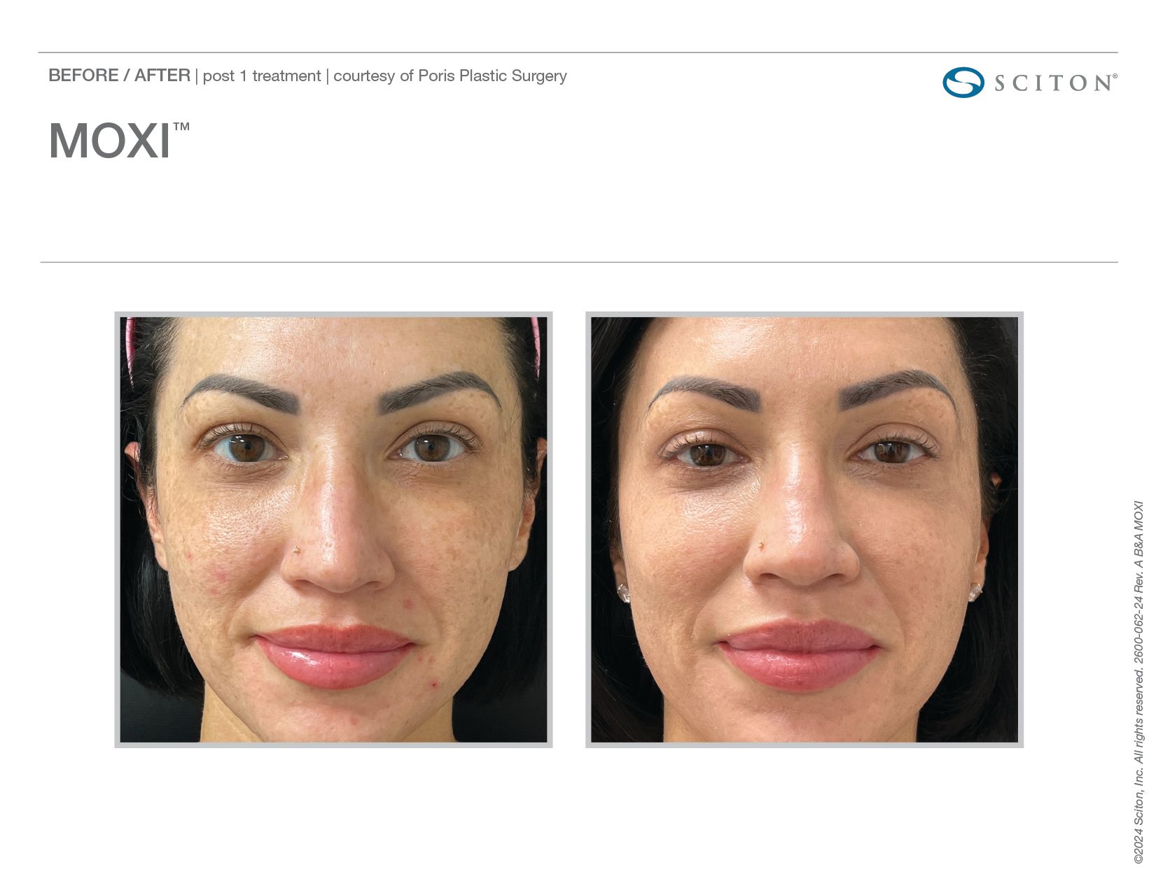 MOXI Before and After Chicago Aesthetics