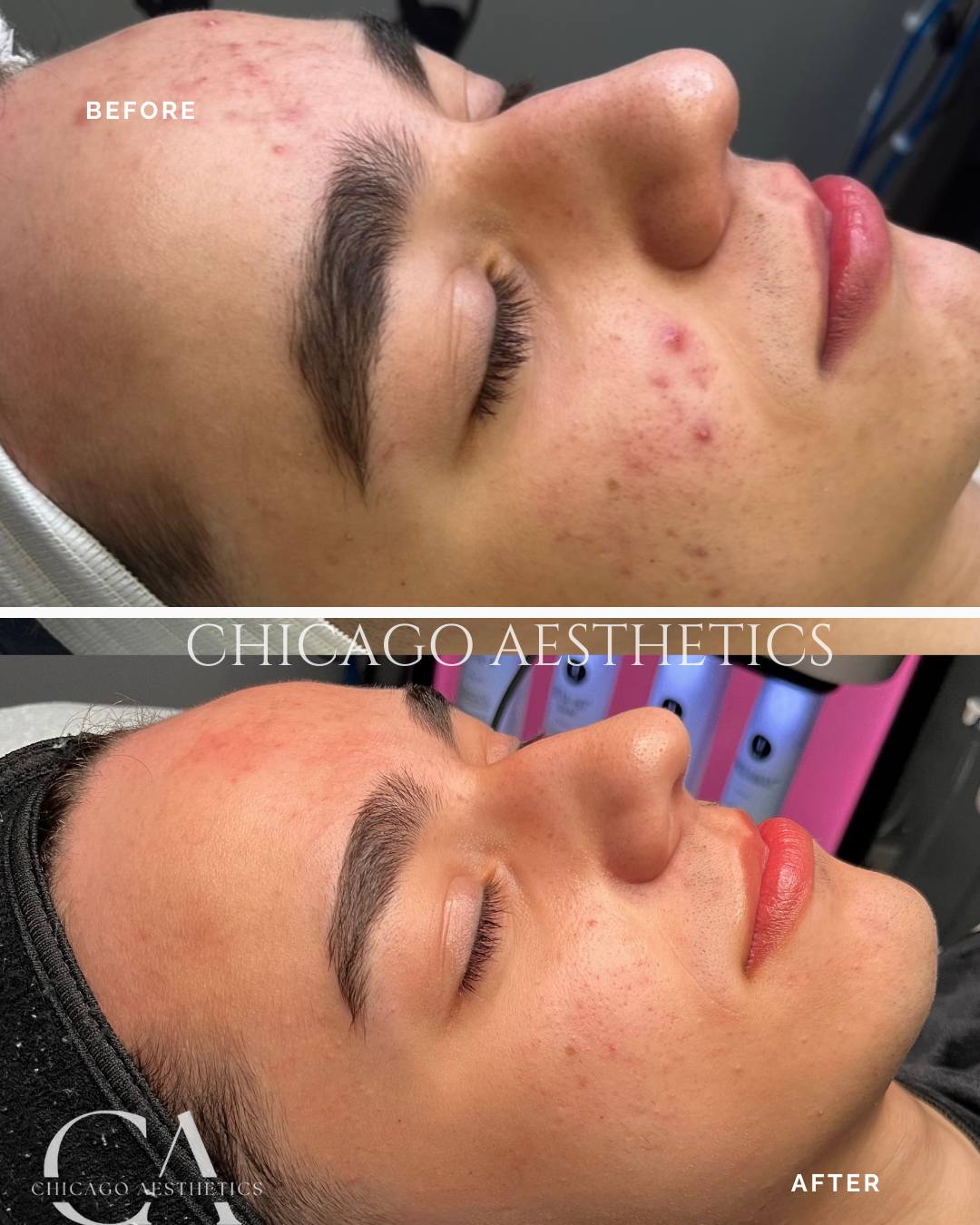 #508 Hydfrafacial Before After Photo Chicago Aesthetics