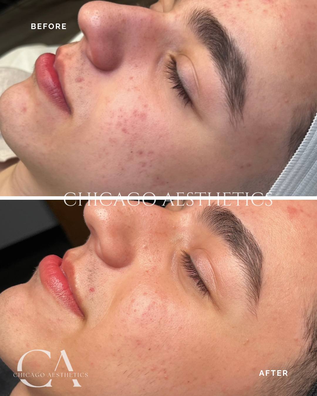 #508 Hydfrafacial Before After Photo Chicago Aesthetics