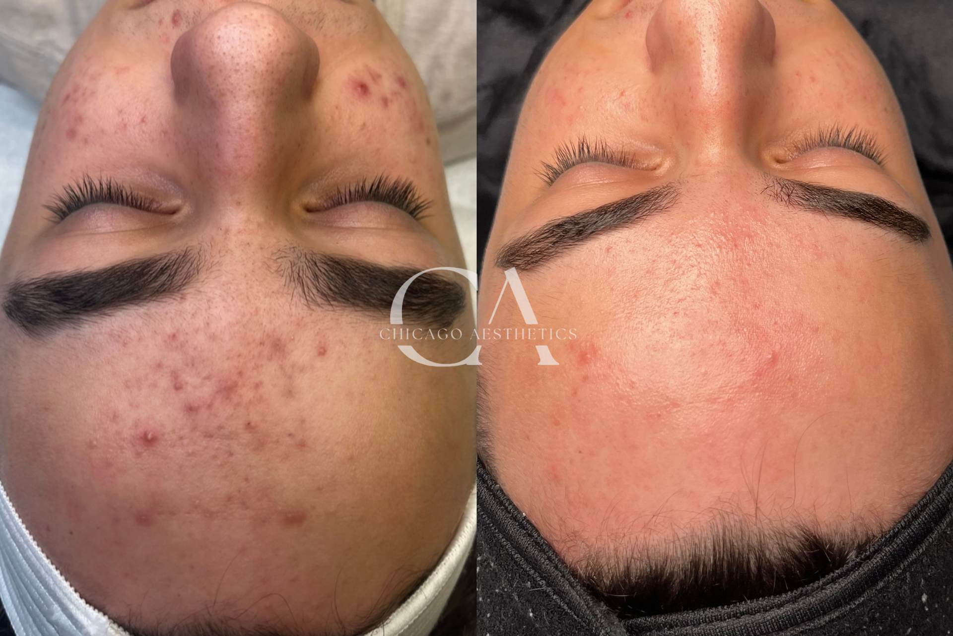 custom facials, chemical peels, Hydrafacial - 6 sessions Chicago Aesthetics