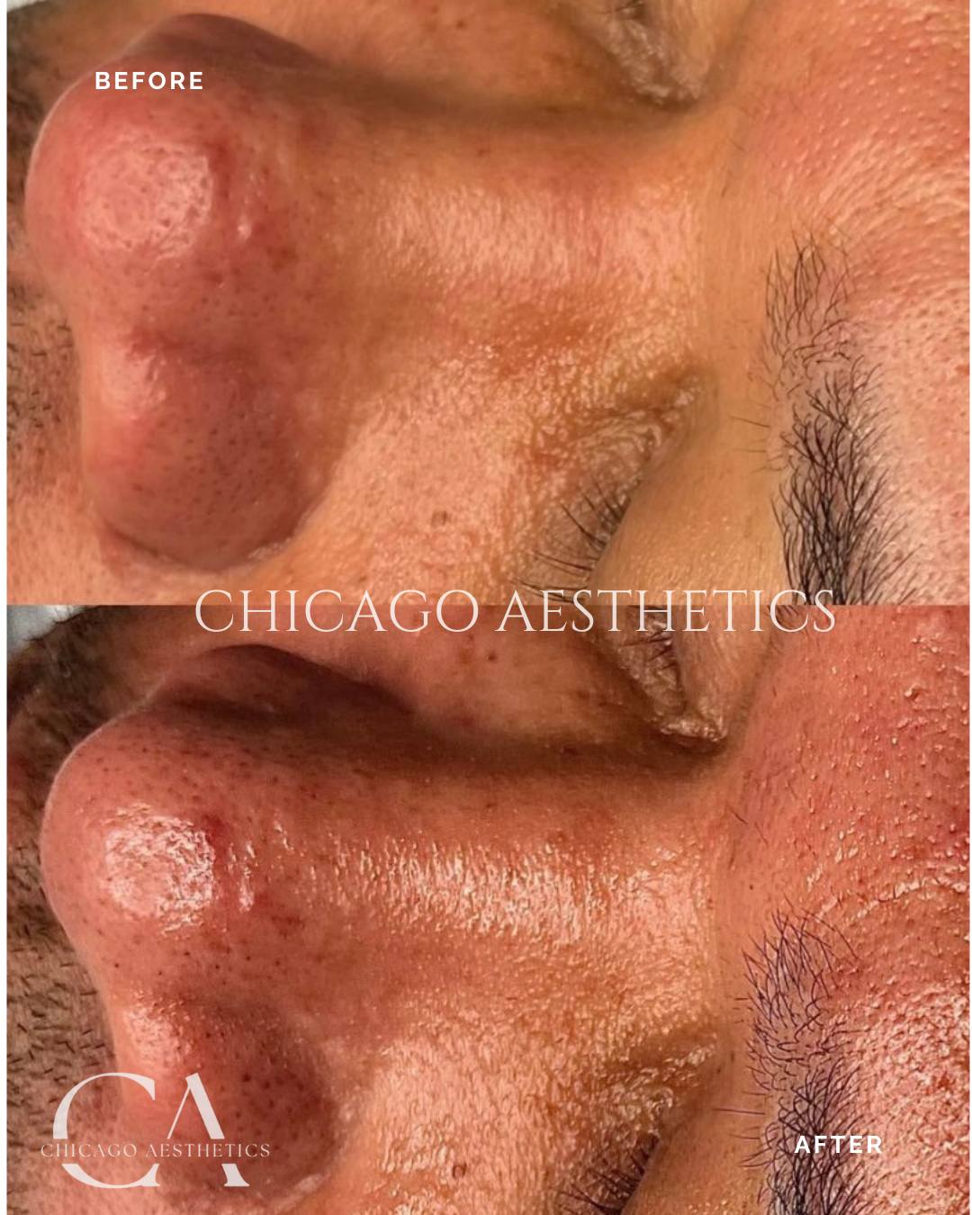hydrafacial before and after chicago aesthetics