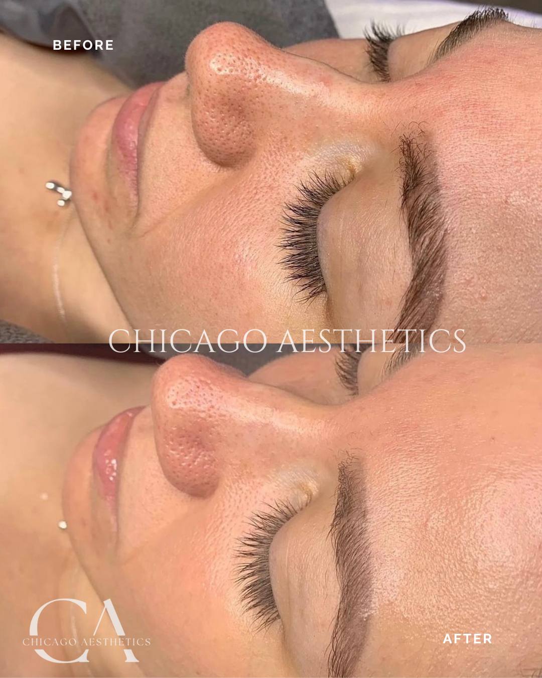 hydrafacial before and after photo chicago aesthetics