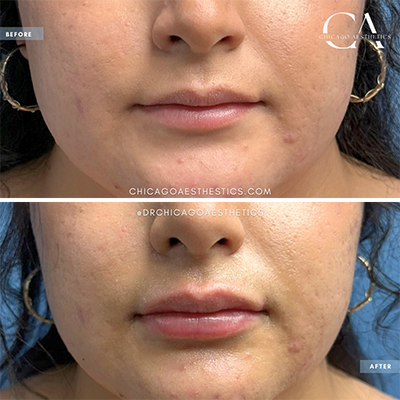 2372001 Lip Filler Carol Donohue Chicago