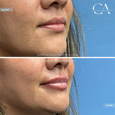 2372001 Lip Filler Carol Donohue Chicago