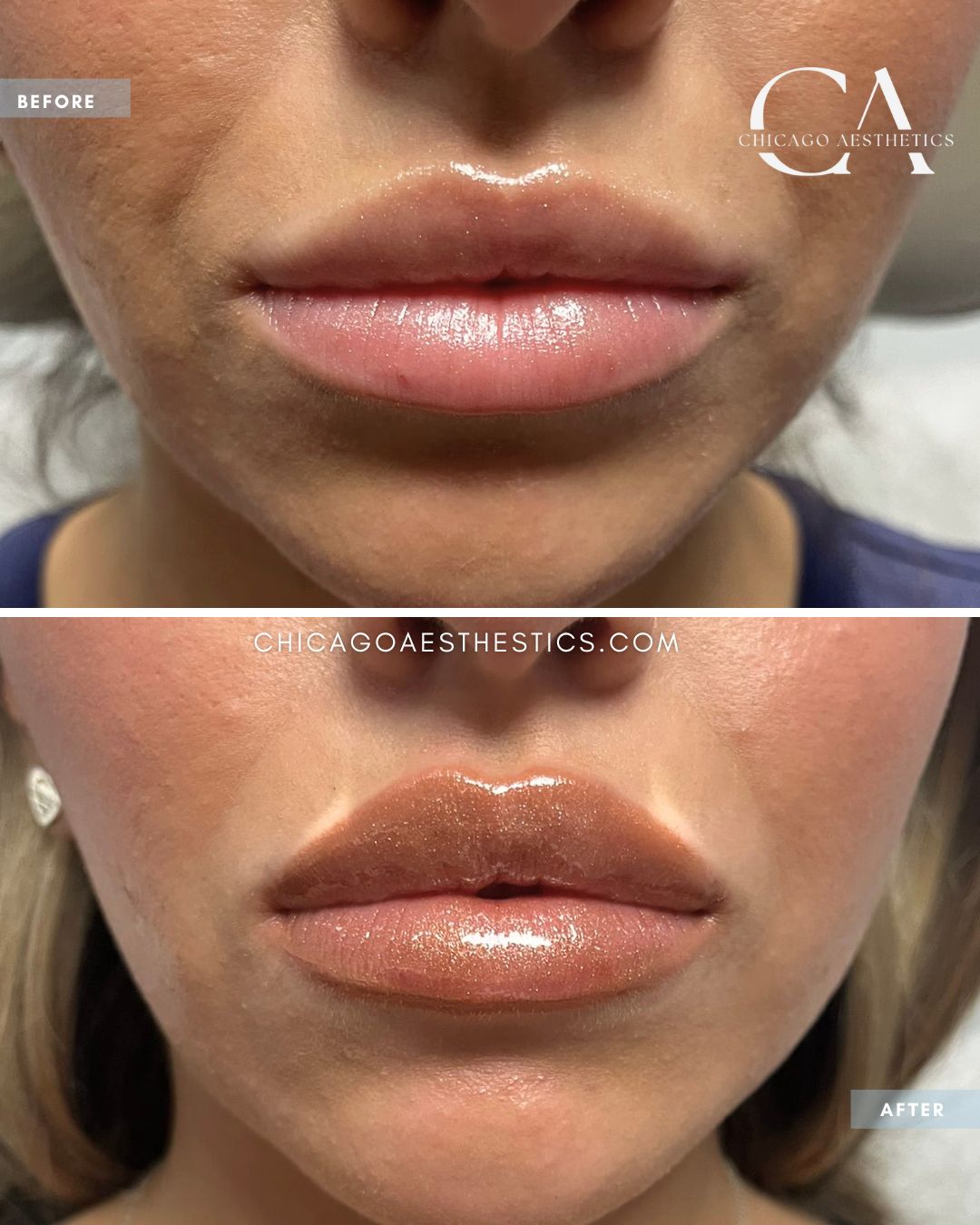 2395102 Lip Filler Carol Donohue Chicago