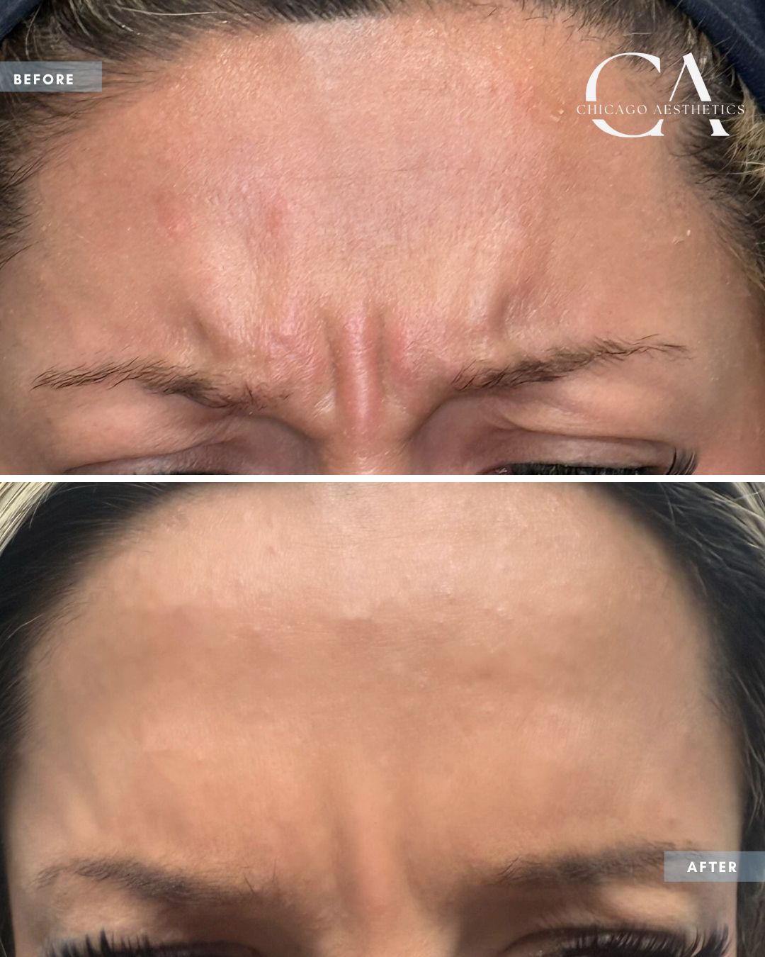 2395102 Brow Botox Carol Donohue
