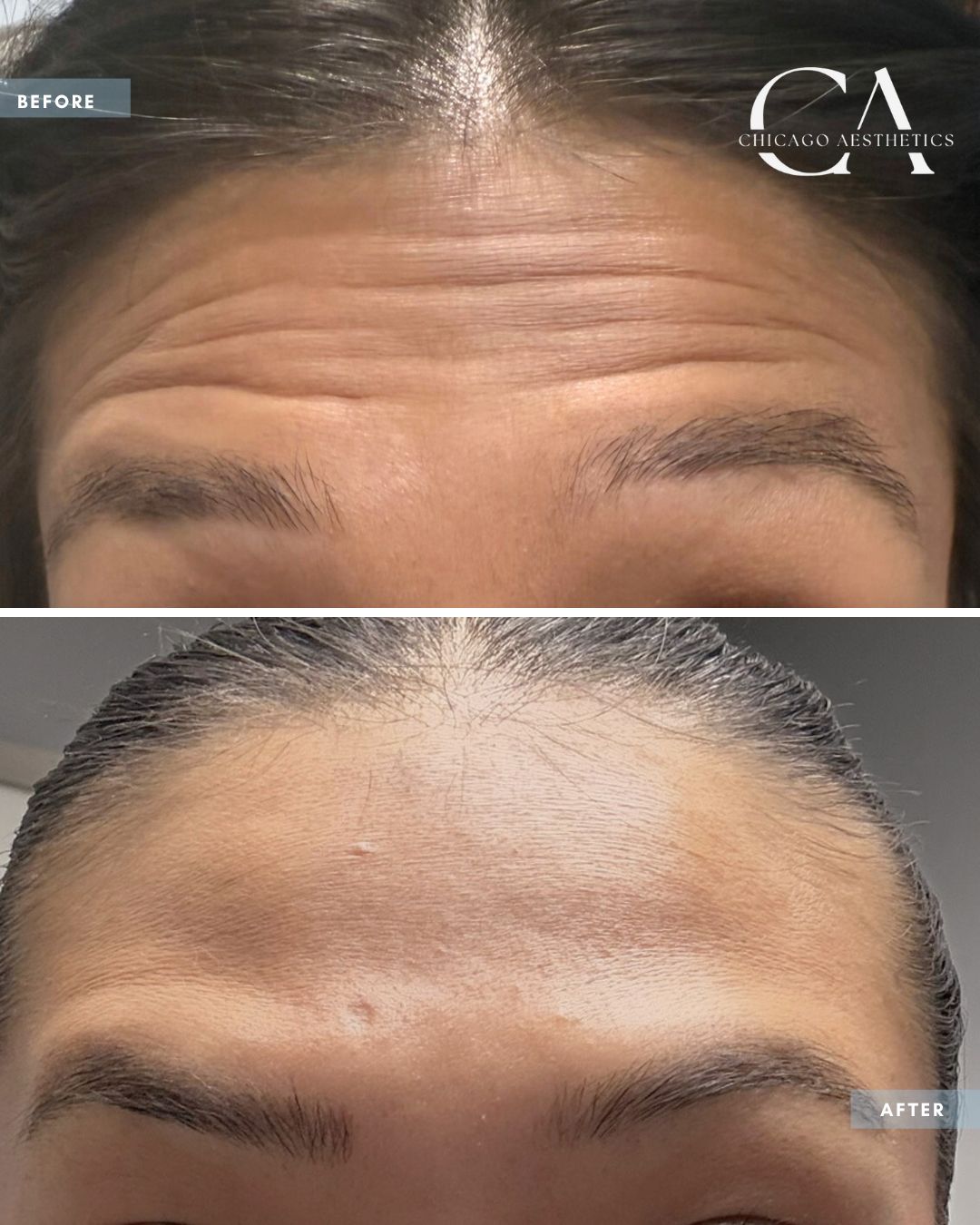 1765620 Forehead Botox Carol Donohue Chicago