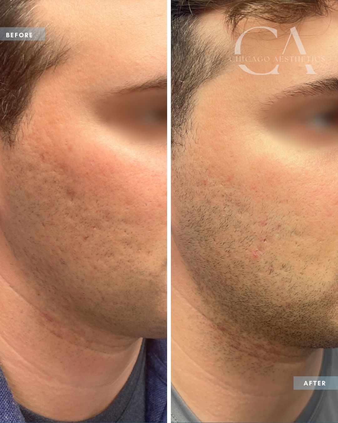 1989010 Morpheus 8 and IPL Alison Falada Chicago