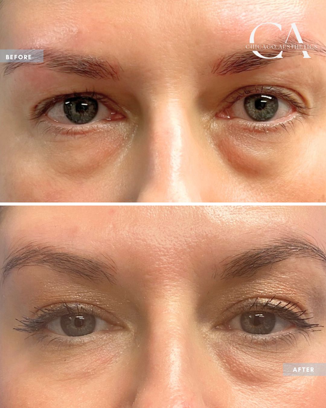2048088 Sofwave Eyelid Lift Alison Falada Chicago