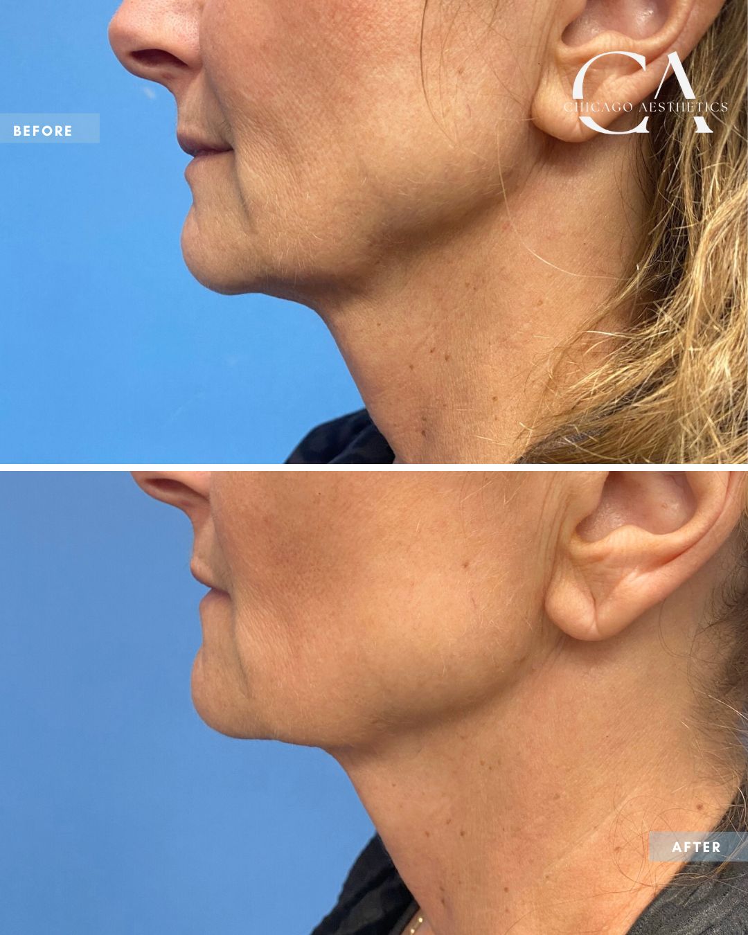 212254 Morpheus8 Alison Falada Chicago