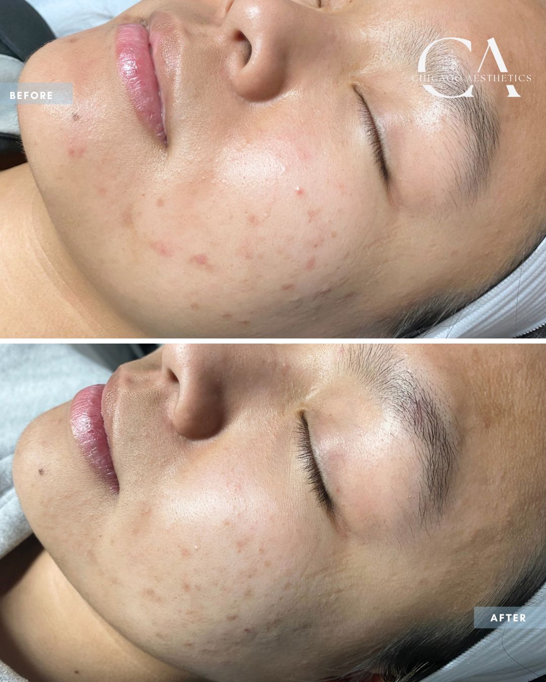 2272638 Chemical Peel Alison Falada Chicago