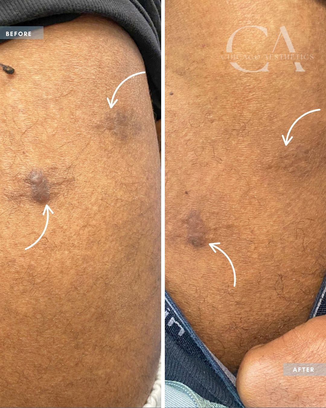 2348598 Moxi Laser Alison Falada Chicago