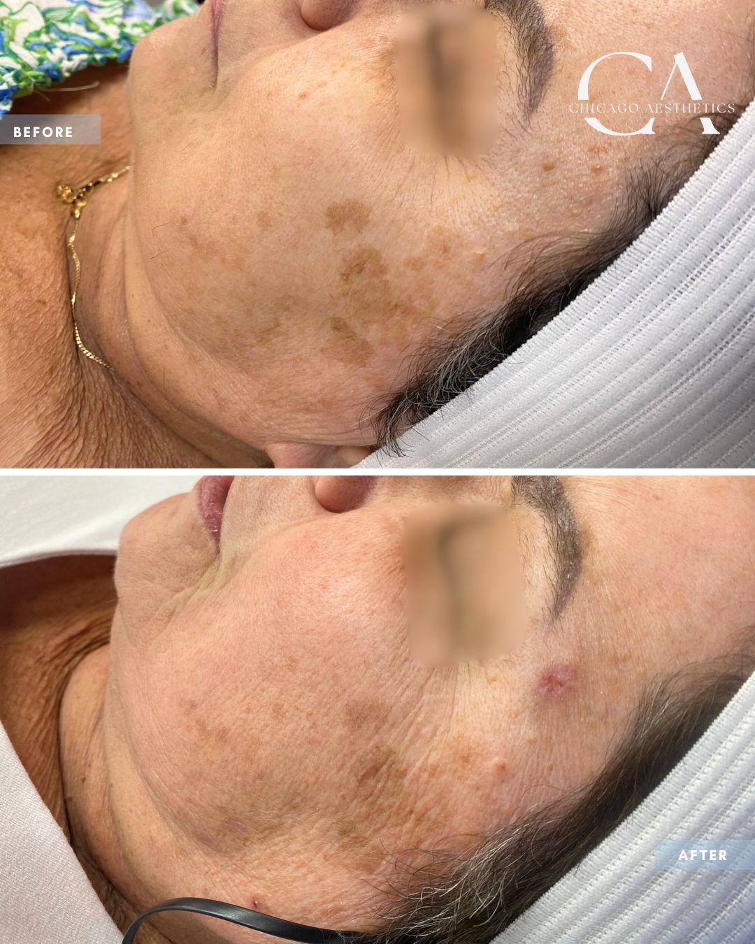 2384489 Moxi Laser Alison Falada Chicago