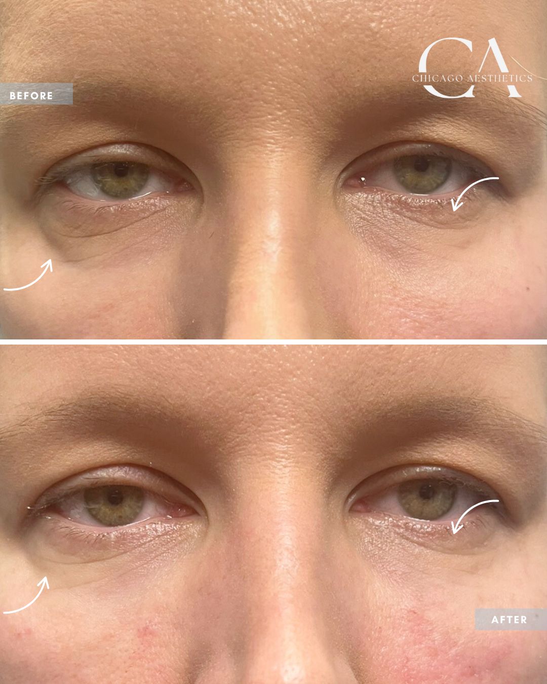 24025 - Under Eye Filler Carol Donohue Chicago